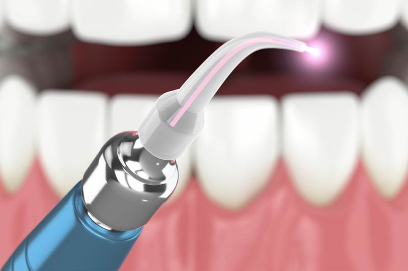 Laser Dentistry in Fresno